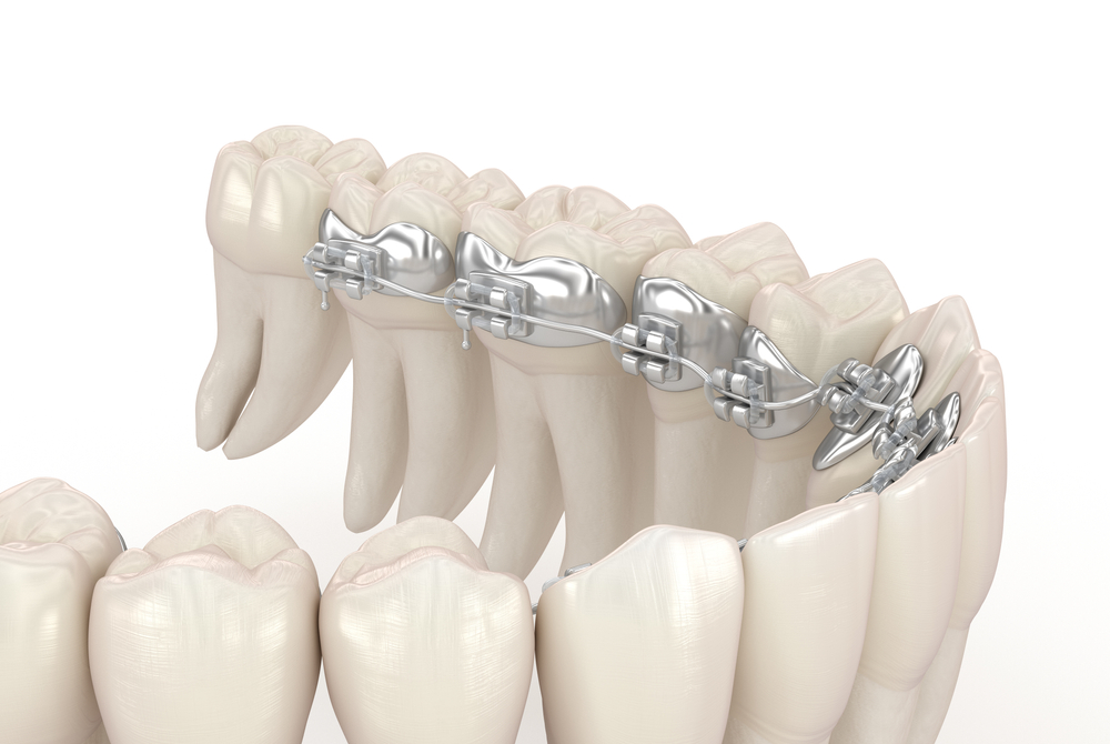 best-lingual-braces-orthodontics-in-mylapore