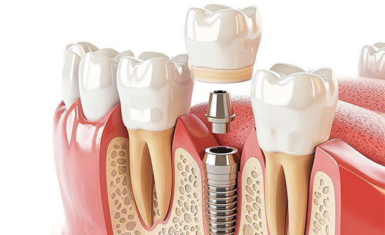 best-restorative-dentistry-in-chennai-at-thangams-dental