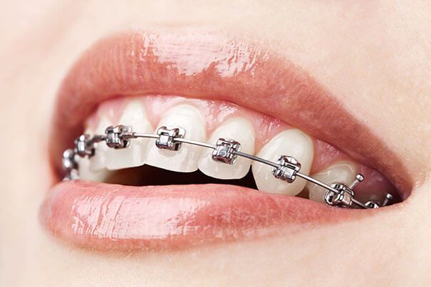 best-traditional-metal-braces-orthodontics-in-chennai